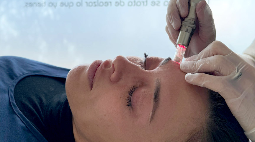 dermapen madrid microneedling poros cicatrices precio 90 euros