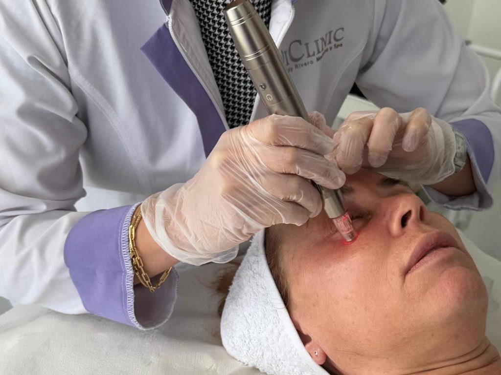 ¿Dermapen está prohibido en España? La verdad y lo que sí debes exigir